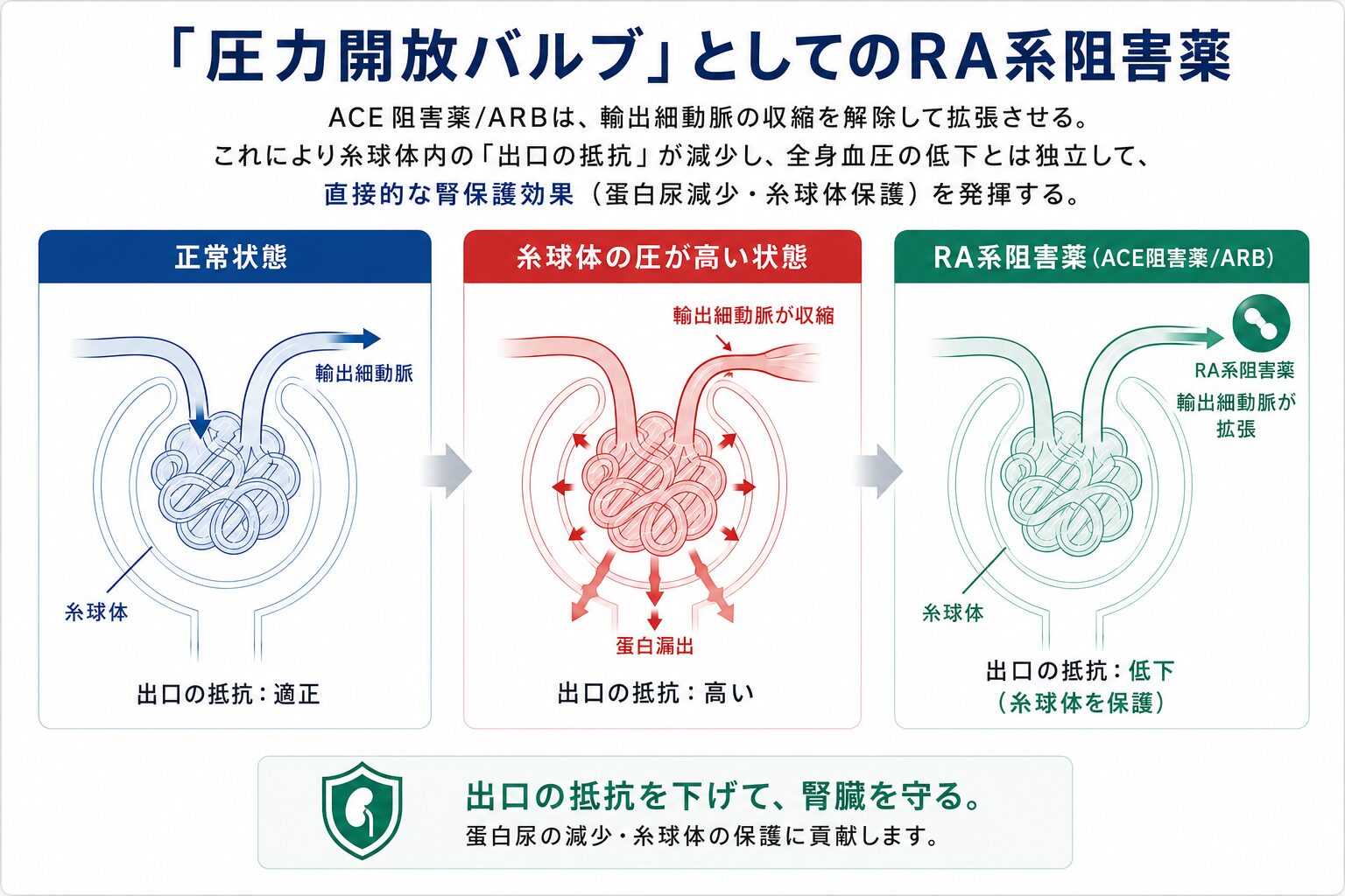 圧力開放バルブとしてのRA系阻害薬：正常状態・糸球体内高血圧・RA系阻害薬投与後の3状態を比較した図解