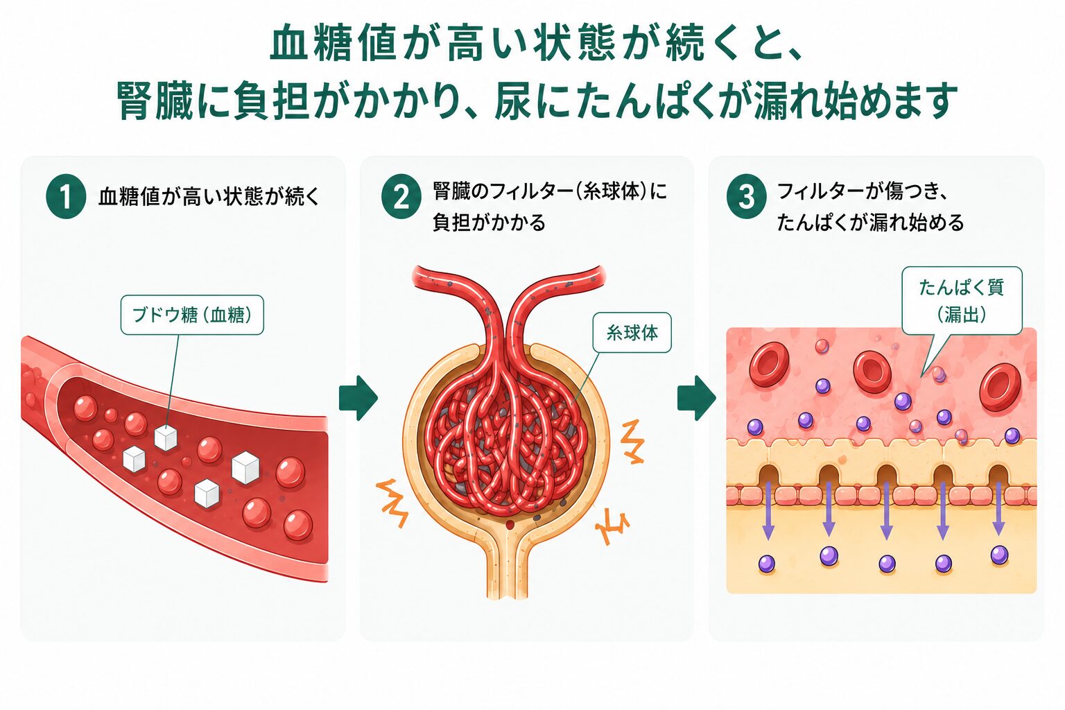 血糖値が高い状態が続くと腎臓の糸球体に負担がかかり、たんぱく尿につながる仕組みを示した3ステップの図解